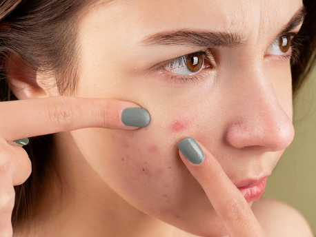 Uren hud, akne eller bumser