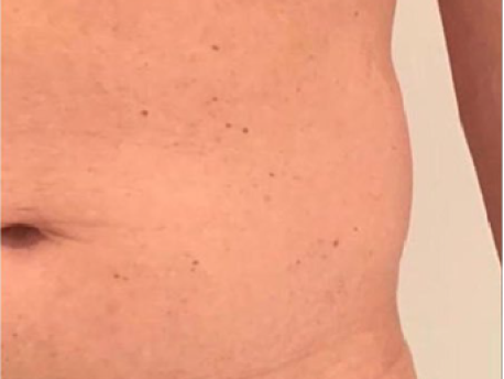 Genstridige fedtdepoter