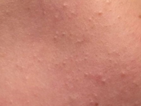 Knopper eller ar i huden