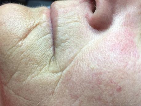 Uønskede rynker og linjer