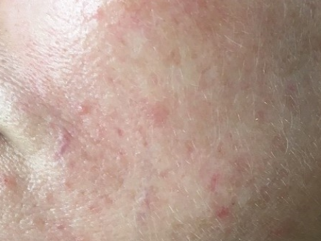 Sensitiv eller irriteret hud