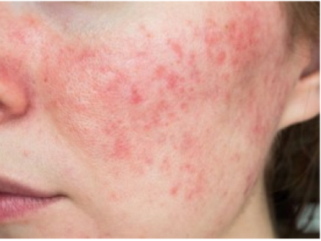 Rødmen eller rosacea